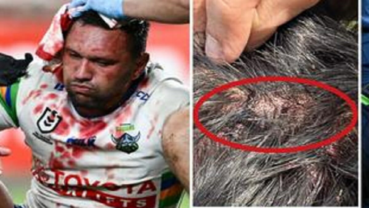 WATCH: Jordan Rapana Head Injury Video Shows head cut after copping knee to the head 2023 - networth, wiki, biography