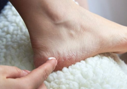 Mẹo trị nứt gót chân hiệu quả ngay tại nhà bạn không nên bỏ lỡ
